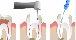 Root Canal